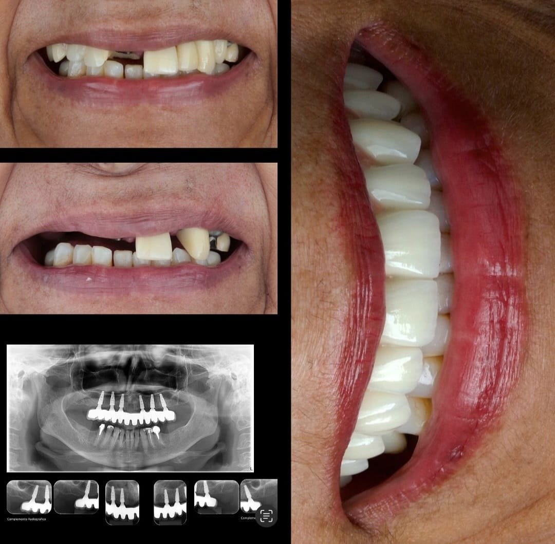 Dr. Lucas Loubach. Implante Dentário #1.1