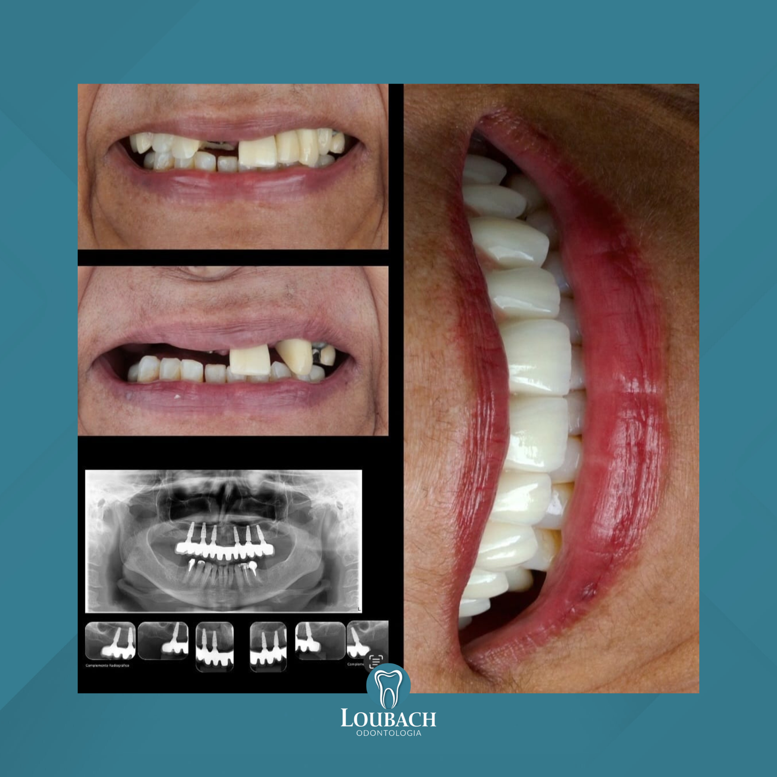 Dr. Lucas Loubach. Implante Dentário #1.2