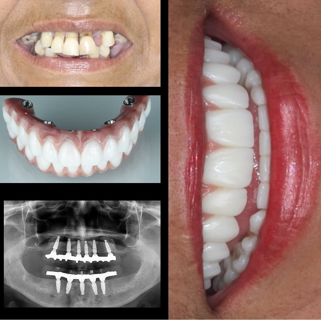 Dr. Lucas Loubach. Implante Dentário #2.1