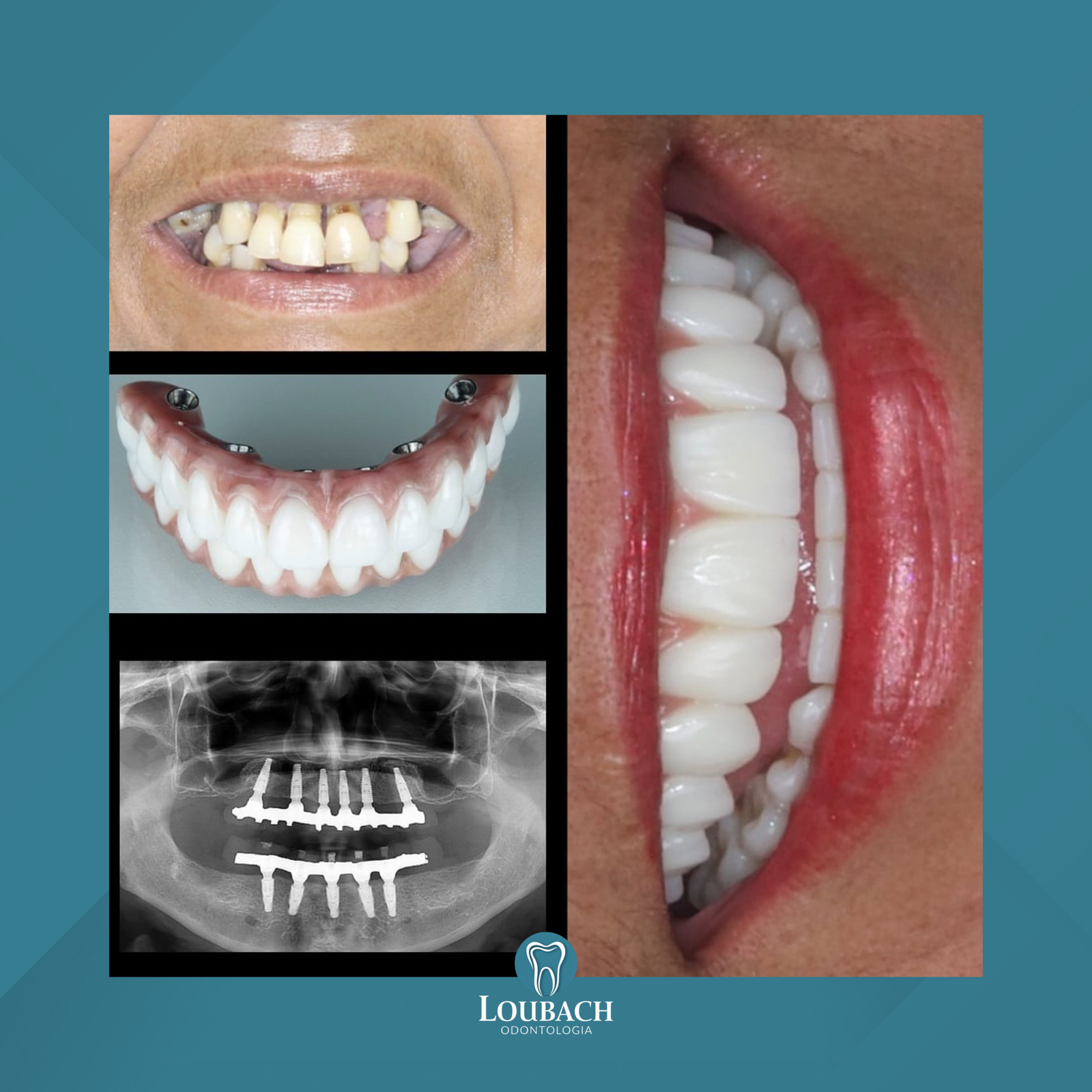 Dr. Lucas Loubach. Implante Dentário #2.2