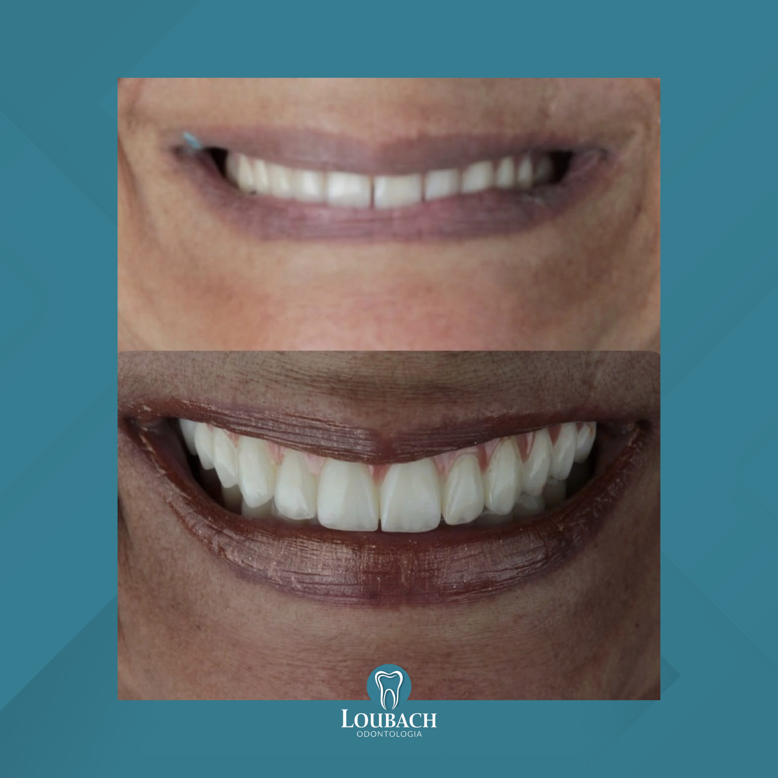 Dr. Lucas Loubach. Lentes de Contato Dental #1.2